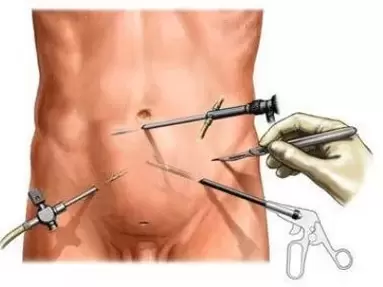 хирургично лечение на хроничен простатит